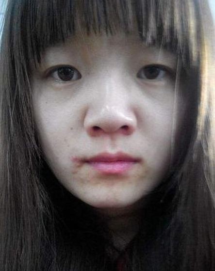 痤疮的致病原因都有哪些呢