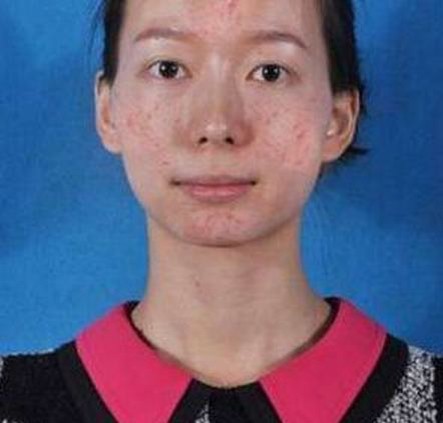 痤疮患者饮食需要注意什么