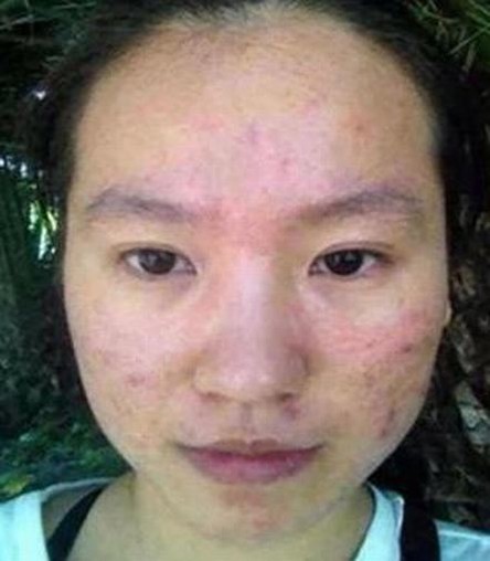 痤疮通常会分布在什么部位
