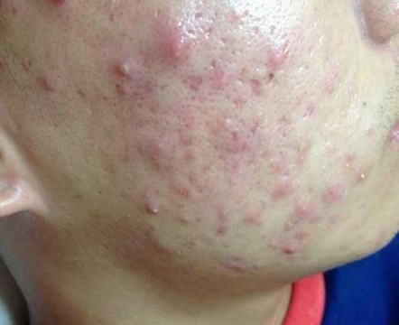 痤疮常见5病因 不同类型需正确治疗