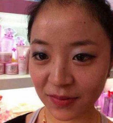 痤疮的病因主要分为四种