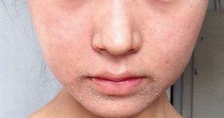 痤疮的常见预防措施包括哪些 要养成良好的生活和饮食习惯