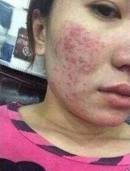 痤疮的发病机理有哪些呢