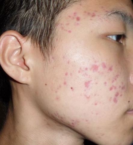 不同部位长痤疮的原因分别是什么