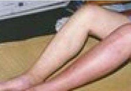 丹毒能吃羊肉吗