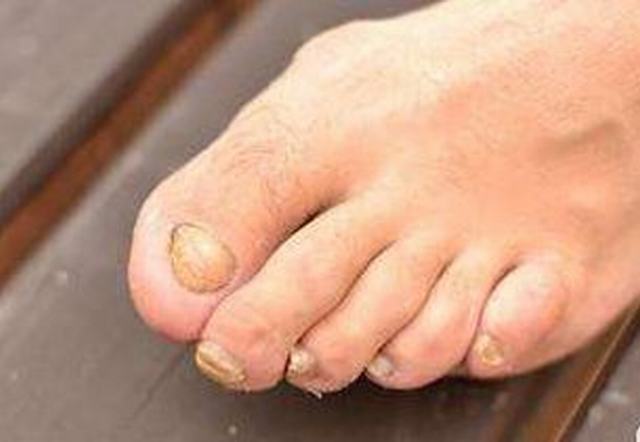 丹毒病人吃什么好