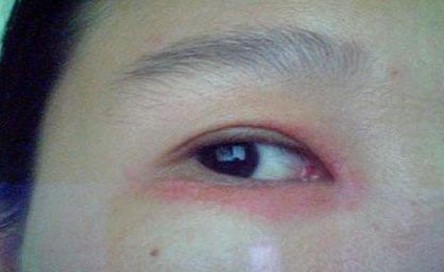 带状疱疹的用药方式 带状疱疹患者应该关注什么
