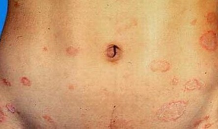 带状疱疹的症状是什么 带状疱疹概述