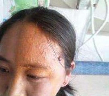带状疱疹病毒怎么治疗 带状疱疹治疗的手法