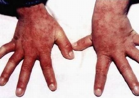 带状疱疹的初期病情  多了解症状提高警惕