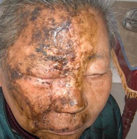 病毒性带状疱疹如何治疗的手法
