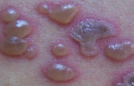 带状疱疹的感染会造成什么
