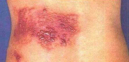 带状疱疹的感染是什么导致的