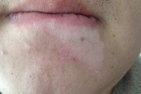 有关白癜风知识
