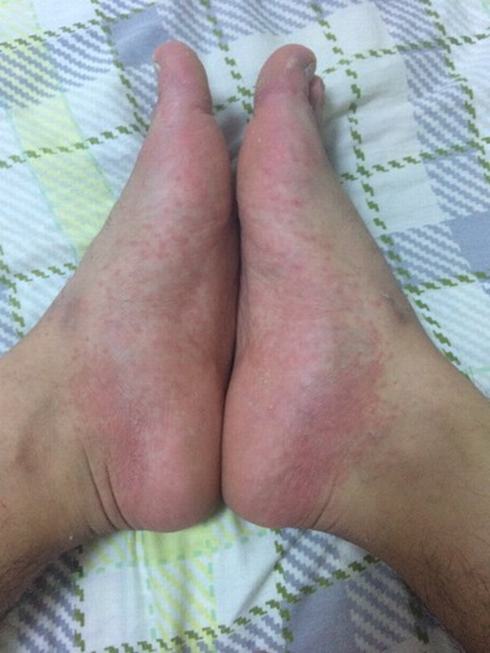 治疗汗疱疹的措施都有什么