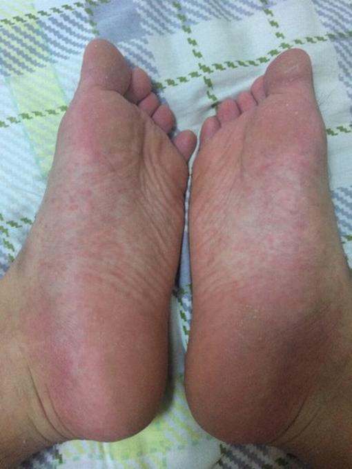 汗疱疹的中医治疗方法是什么