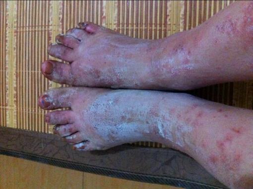 汗疱疹综述