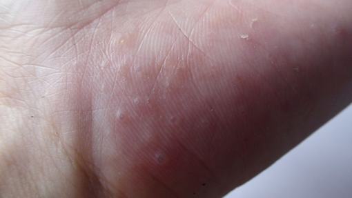 什么是汗疱疹，该如何处理？