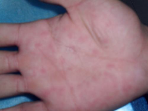 专家提醒汗疱疹患者日常应注意的事项有哪些