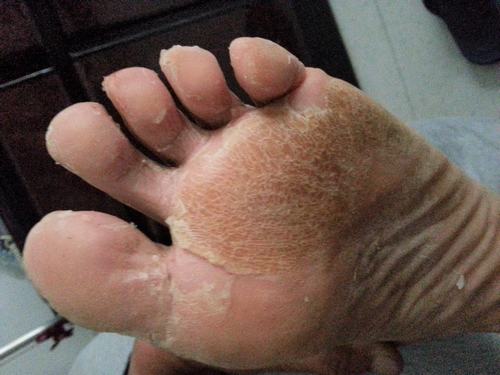 诱发汗疱疹的因素是什么