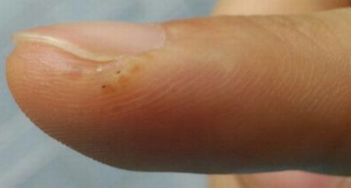手癣与汗疱疹的区别有哪些呢