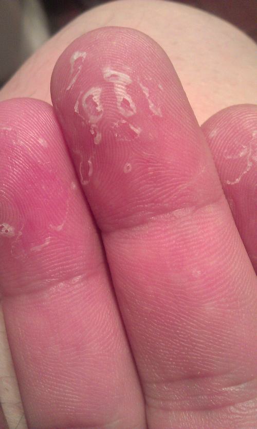 手癣与汗疱疹症状对比