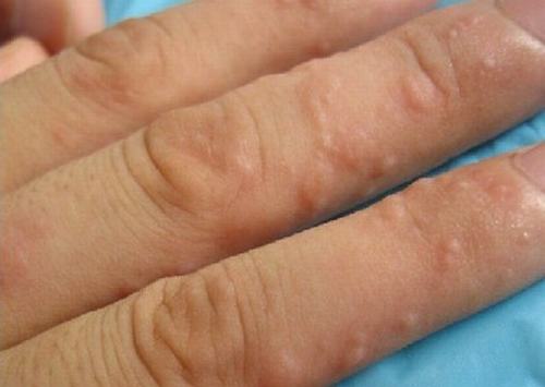 汗疱疹的治疗方法是什么