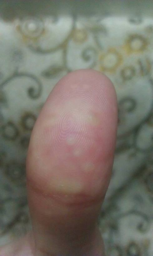汗疱疹护理的措施是什么