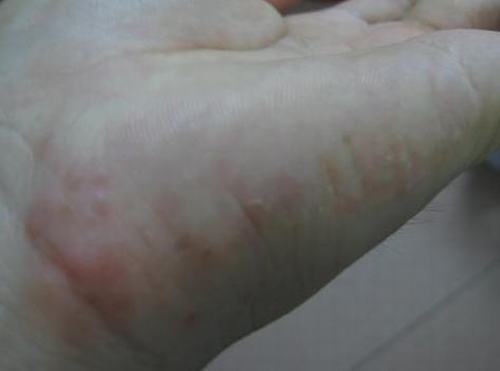 汗疱疹有哪些发病特点