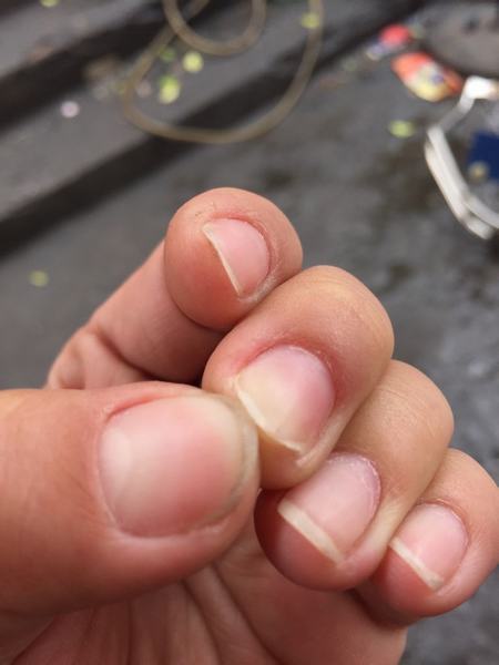灰指甲的产生有哪些原因 