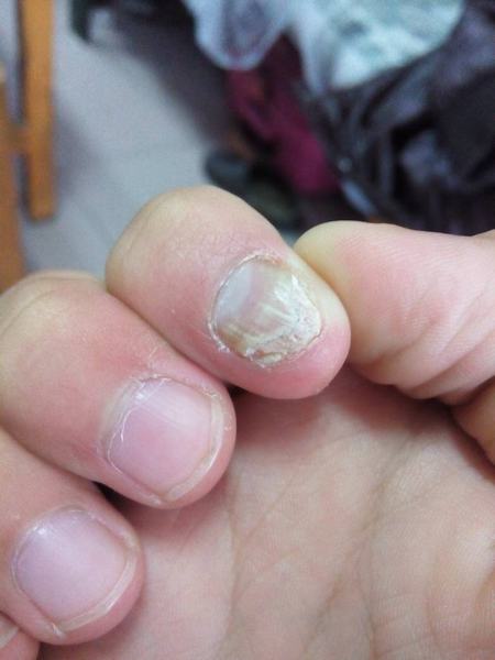 灰指甲常见发病原因