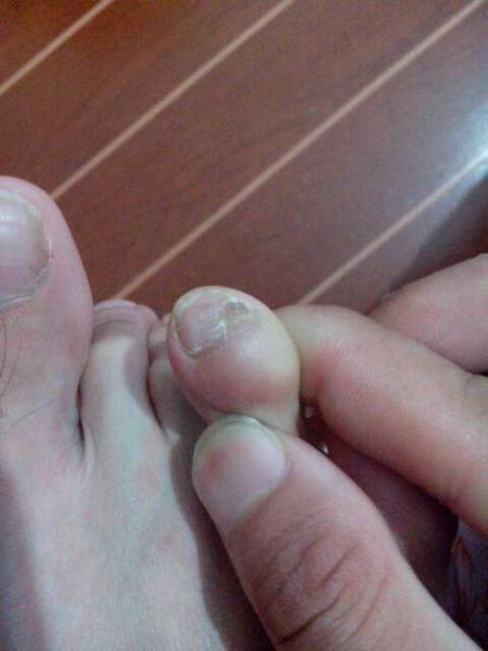 是什么原因诱发了灰指甲的出现