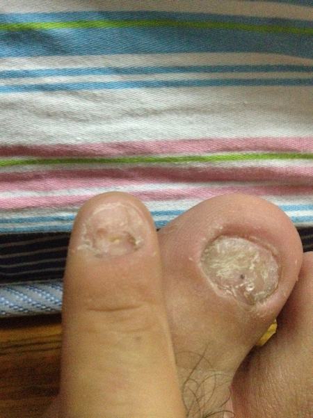 灰指甲的发生是由哪几个原因导致的