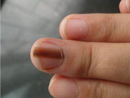 灰指甲患者的发病原因