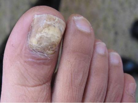 灰指甲的发病原因一般有哪些 
