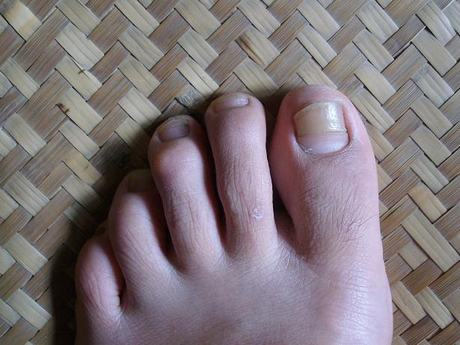灰指甲变肥大的原因是什么