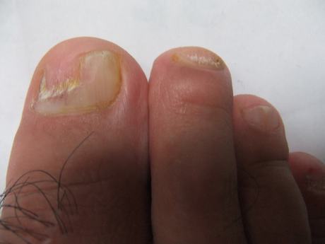灰指甲的主要症状表现