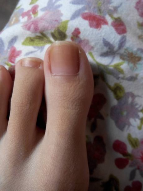 灰指甲的几个症状特点是什么