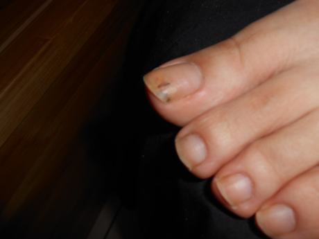 灰指甲的不同症状及表现