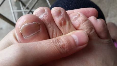 灰指甲症状表现有哪些 