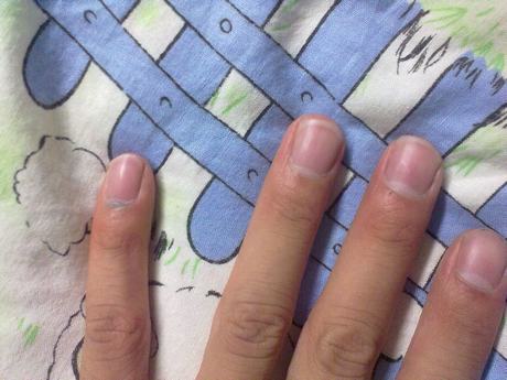 灰指甲的症状以及表现有哪些 