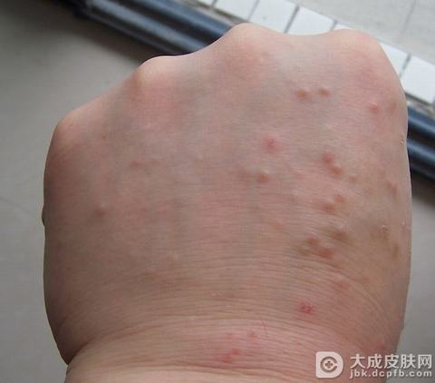 疥疮早期症状表现