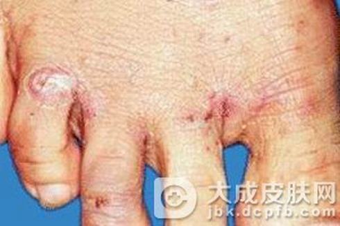 疥疮要如何准确鉴别 