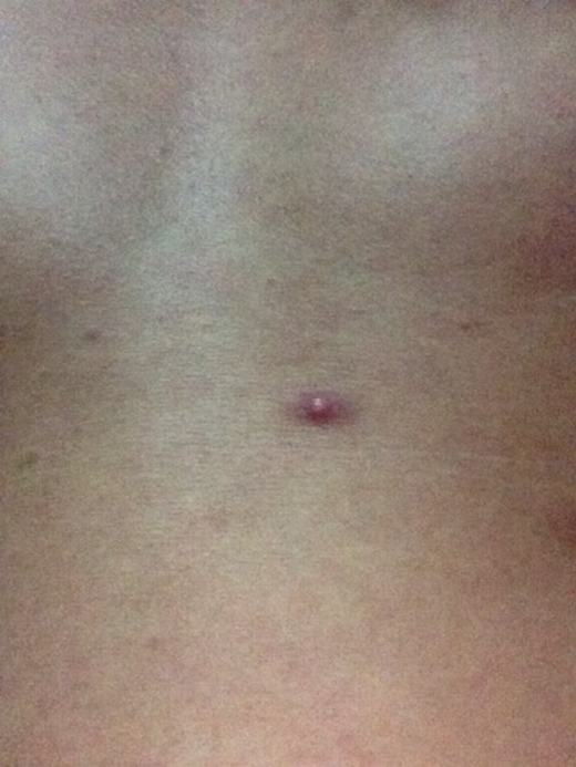 淋病怎么预防 