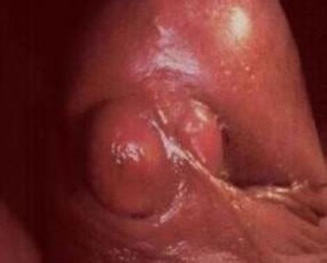 尿道疼痛是淋病的的症状吗？