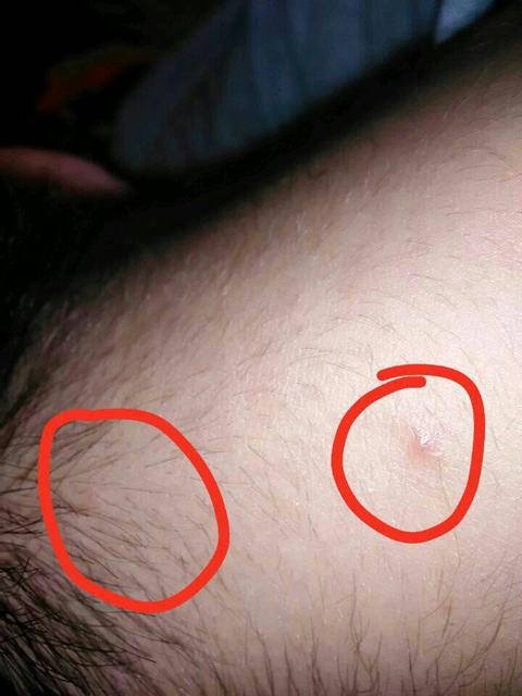 长期睡眠不足饮食不当当心患上毛囊炎