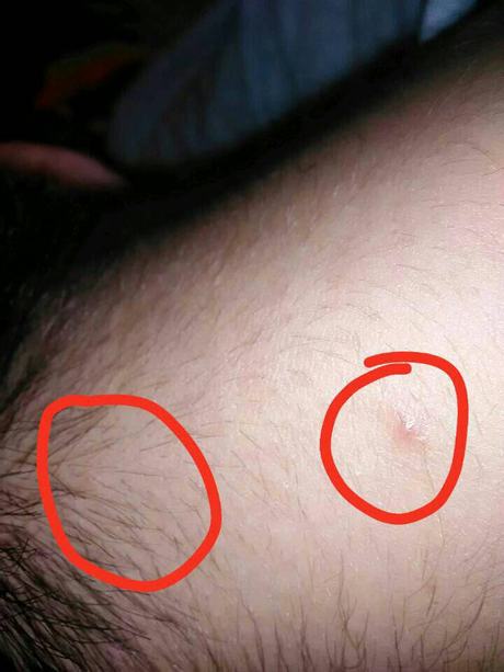 毛囊炎皮肤病是什么原因引起的？