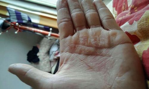 导致玫瑰糠疹发病的原因是什么