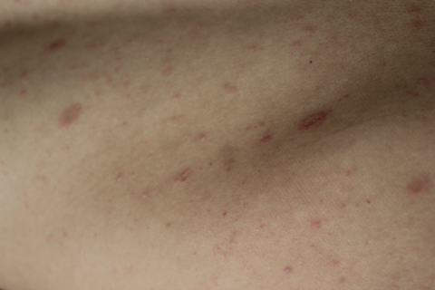 急性玫瑰糠疹症状有什么