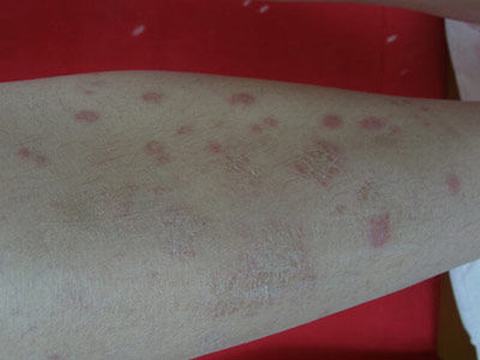 玫瑰糠疹的主要症状是什么